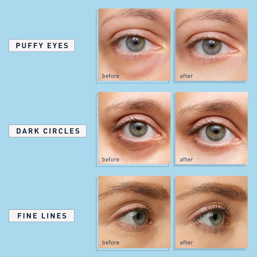 Enaskin Naturals Under Eye Patches for Dark Circles: 30 Pairs Retinol Collagen Eye Gels Mask - Reduce Wrinkles Puffy &amp; Bags - Skin Treatment Pads - Anti Aging Moisturizer For Women (Blue)