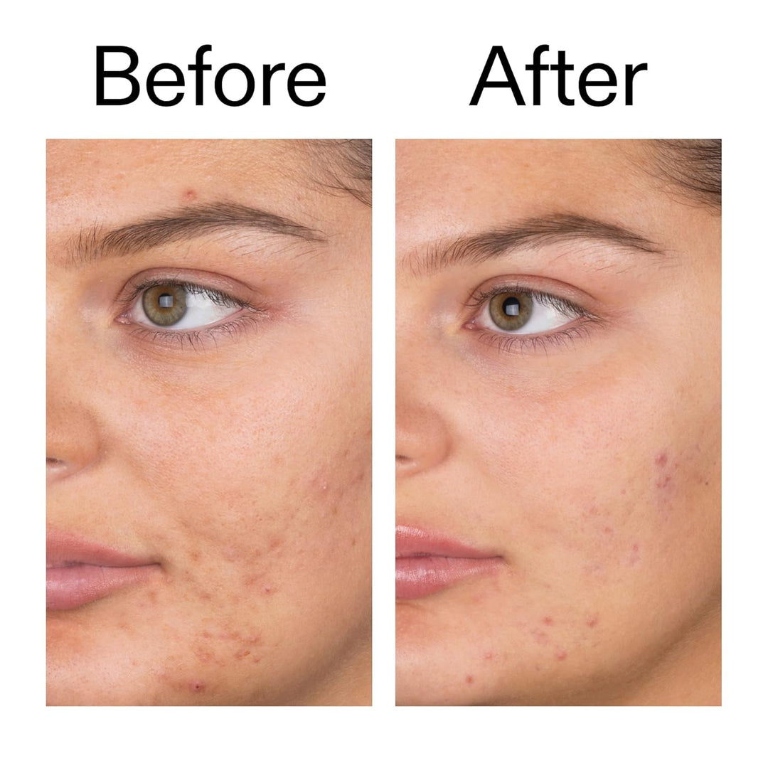 The INKEY List Salicylic Acid Cleanser - Daily Exfoliating Cleanser with 2% Salicylic Acid &amp; Zinc PCA, Unclogs Pores, Anti Acne, Reduces Blackheads &amp; Excess Oil for Clearer Skin