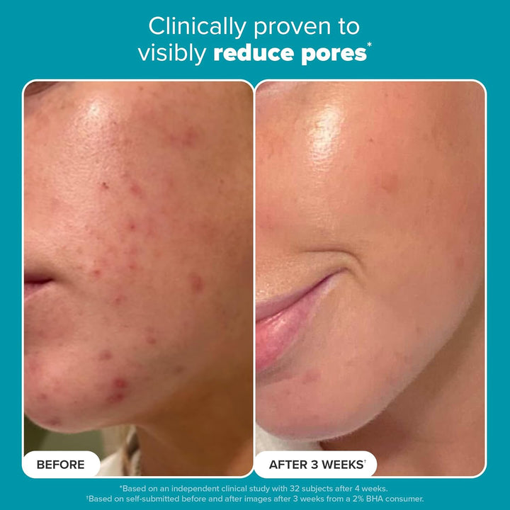 Paula's Choice SKIN PERFECTING 2% BHA Liquid Exfoliant Polish, Salicylic Acid Facial Exfoliator Polish for Enlarged Pores, Wrinkles & Fine Lines, Suitable for Blackhead-Prone Skin, Fragrance-Free