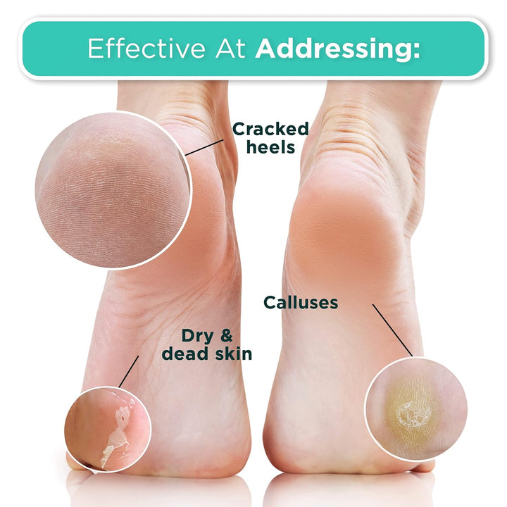 DERMORA Foot Peel Mask | Skin Exfoliating Foot Masks for Dry, Cracked Feet &amp; Callus Removal | Dead Skin Exfoliator for Baby Soft Feet | Pack of 2 | Regular (Fits up to Men 10 / Women 11) | Original
