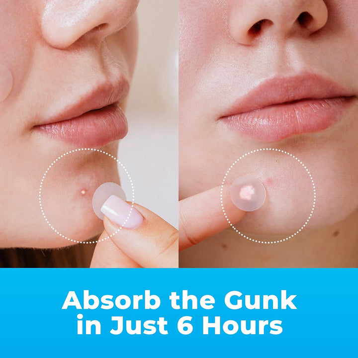 Pimple Patches for Face (120 Patches), Hydrocolloid Acne Patches with Tea Tree Oil, Pimple Patch Pimple Stickers - Hydrocolloid Patch Acne Dots - Acne Pimple Patches For Face - Zit Patches